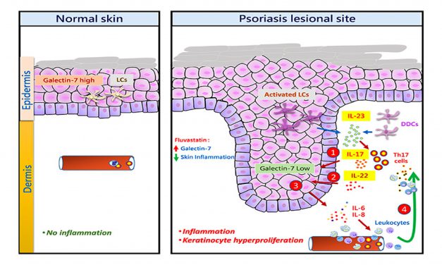A new approach for treatment of psoriasis: identification of galectin-7 as a novel regulator of inflammation in psoriasis